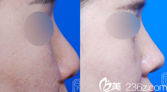 韓國(guó)伯恩整形外科鼻綜合效果圖 韓國(guó)伯恩整形外科鼻綜合效果圖