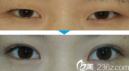 韓國(guó)柏恩整形外科眼綜合效果圖 韓國(guó)柏恩整形外科眼綜合效果圖