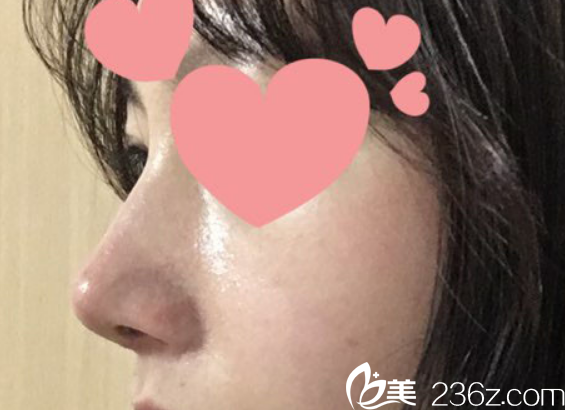 韓國(guó)柏恩整形醫(yī)院鷹鉤鼻整形術(shù)后圖