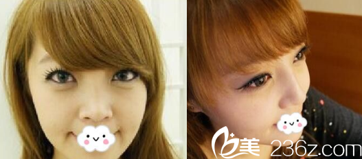 公開！煙臺鵬愛整形醫(yī)院pk煙臺美神美容醫(yī)院，手術(shù)價格+鼻綜合自體脂肪填充切開雙眼皮實例