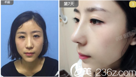 煙臺(tái)鵬愛整形醫(yī)院魏璐術(shù)前照片1