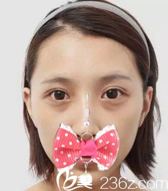 面部填充前的照片 面部填充前的照片