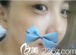 濮陽源美溫賞做的面部脂肪填充 濮陽源美溫賞做的面部脂肪填充