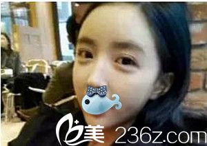 濮陽源美溫賞做的面部脂肪填充術(shù)后2周 濮陽源美溫賞做的面部脂肪填充術(shù)后2周