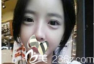 濮陽源美溫賞做的面部脂肪填充術(shù)后1個月 濮陽源美溫賞做的面部脂肪填充術(shù)后1個月