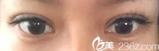 埋線雙眼皮線掉了變成三眼皮怎么辦 看我找韓國本沐整形都鎮(zhèn)雨做雙眼皮失敗二次修復案例