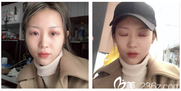 找廣州軍美產(chǎn)慎之做完雙眼皮第二天效果圖 找廣州軍美產(chǎn)慎之做完雙眼皮第二天效果圖