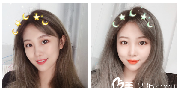 廣州軍美整形醫(yī)院產(chǎn)慎之醫(yī)生雙眼皮案例術(shù)后三個(gè)月圖片 廣州軍美整形醫(yī)院產(chǎn)慎之醫(yī)生雙眼皮案例術(shù)后三個(gè)月圖片