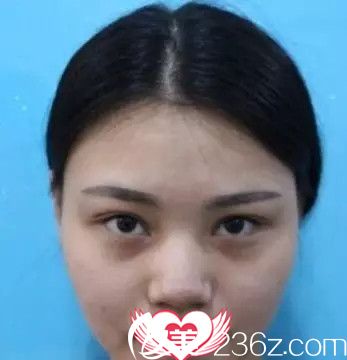 術(shù)前眼睛不好看沒神韻 術(shù)前眼睛不好看沒神韻