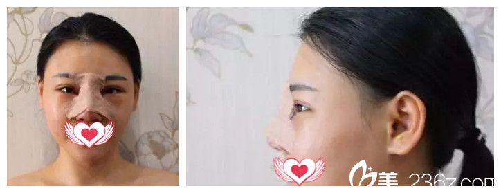 雙眼皮后做鼻綜合術(shù)后即刻 雙眼皮后做鼻綜合術(shù)后即刻