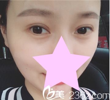 外切眼角手術(shù)后恢復(fù)效果 外切眼角手術(shù)后恢復(fù)效果