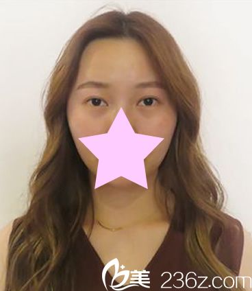 外切眼角手術(shù)前照片 外切眼角手術(shù)前照片