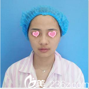 在北京京美做鼻整形前照片 在北京京美做鼻整形前照片