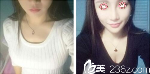 張寶譽(yù)假體隆胸術(shù)后半個(gè)月 張寶譽(yù)假體隆胸術(shù)后半個(gè)月