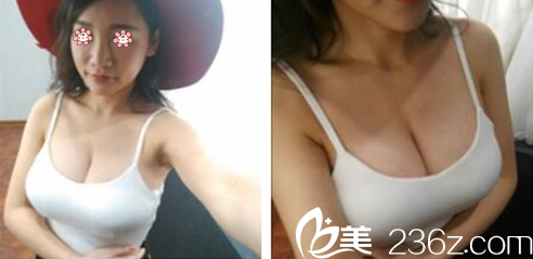 烏魯木齊伊麗莎白整形假體豐胸術(shù)后一個(gè)月 烏魯木齊伊麗莎白整形假體豐胸術(shù)后一個(gè)月