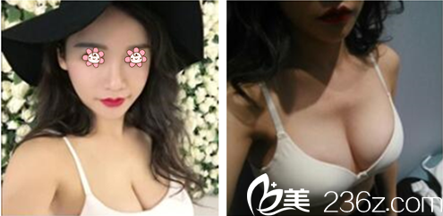 在新疆A優(yōu)醫(yī)美-王蛟整形和烏魯木齊伊麗莎白整形之間做麥格水滴形假體隆胸我選了后者。