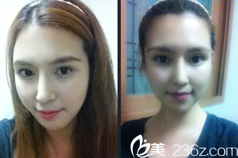 術(shù)后30天的我