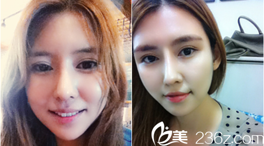  韓國愛我整形醫(yī)院做輪廓手術(shù)真的厲害，我做完顴骨、下頜角和下巴后挺好看的