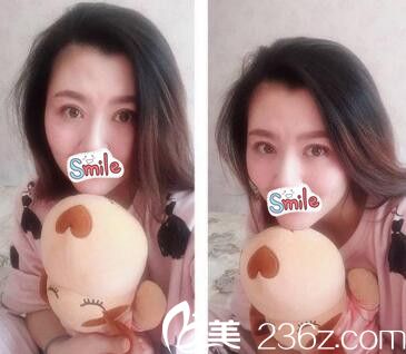 洛陽愛尚雙眼皮手術(shù)后2個(gè)月 洛陽愛尚雙眼皮手術(shù)后2個(gè)月