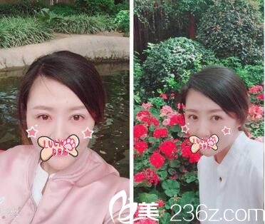 看我在洛陽愛尚做的雙眼皮手術(shù)恢復(fù)照 第二天拿掉紗布就去上班