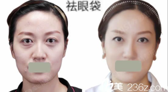 長(zhǎng)沙愛思特整形美容祛眼袋效果對(duì)比圖
