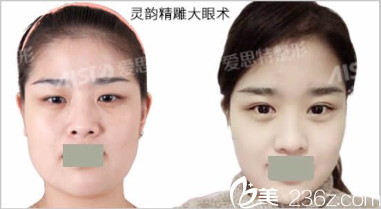 長(zhǎng)沙愛思特整形醫(yī)院雙眼皮案例圖