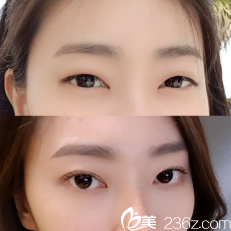 韓國(guó)純真醫(yī)院崔宰源雙眼皮實(shí)例圖