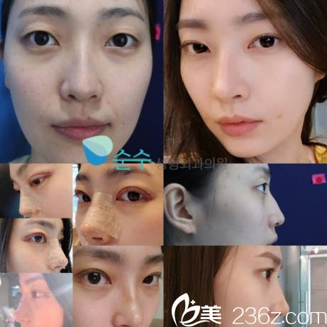 崔宰源院長雙眼皮隆鼻效果好嗎 崔宰源院長雙眼皮隆鼻效果好嗎