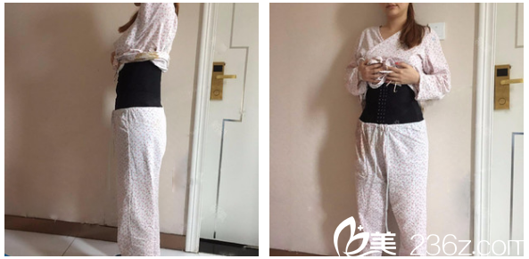 廣州星團整形醫(yī)院黃立斌吸脂術(shù)后效果圖 廣州星團整形醫(yī)院黃立斌吸脂術(shù)后效果圖