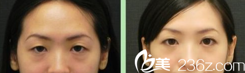 韓國Prima整形外科醫(yī)院祛眼袋案例 韓國Prima整形外科醫(yī)院祛眼袋案例