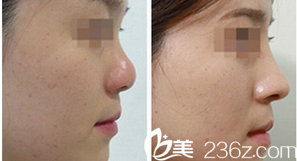 韓國Prima整形外科醫(yī)院硅膠隆鼻效果 韓國Prima整形外科醫(yī)院硅膠隆鼻效果