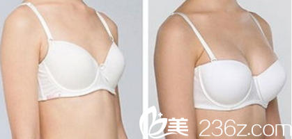 韓國Prima整形外科醫(yī)院假體隆胸案例 韓國Prima整形外科醫(yī)院假體隆胸案例