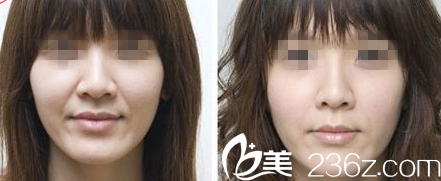 韓國Prima整形外科醫(yī)院面部除皺效果 韓國Prima整形外科醫(yī)院面部除皺效果