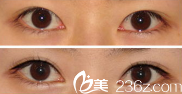 韓國Prima整形外科醫(yī)院郭赫俊雙眼皮效果 韓國Prima整形外科醫(yī)院郭赫俊雙眼皮效果