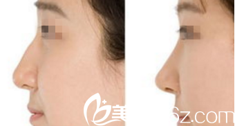 韓國Prima整形外科醫(yī)院郭赫俊鷹鉤鼻矯正案例 韓國Prima整形外科醫(yī)院郭赫俊鷹鉤鼻矯正案例