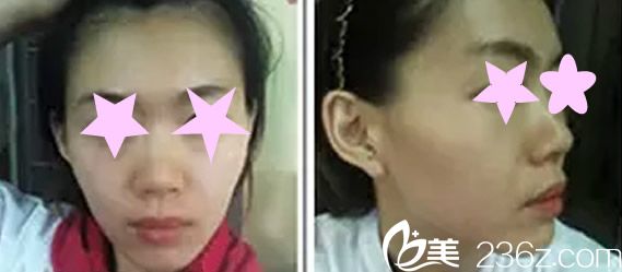 自體軟骨隆鼻手術前照片 自體軟骨隆鼻手術前照片