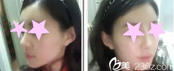 channel整形外科醫(yī)院自體軟骨隆鼻手術兩個月后恢復效果 channel整形外科醫(yī)院自體軟骨隆鼻手術兩個月后恢復效果