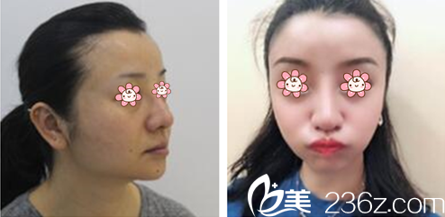 金仁哲院長面部輪廓案例 金仁哲院長面部輪廓案例