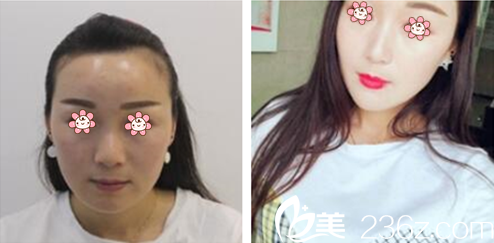 申?yáng)|敏院長(zhǎng)面部輪廓案例 申?yáng)|敏院長(zhǎng)面部輪廓案例