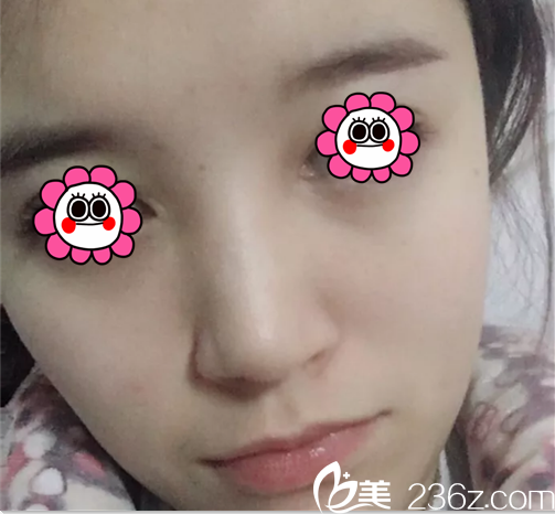 在韓國(guó)Prima整形醫(yī)院做鼻之前照片 在韓國(guó)Prima整形醫(yī)院做鼻之前照片