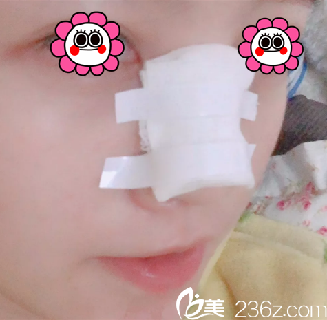 郭赫俊鼻綜合案例第3天效果 郭赫俊鼻綜合案例第3天效果