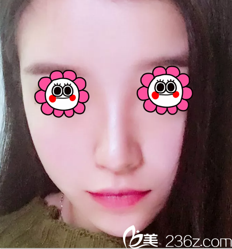 韓國(guó)Prima整形醫(yī)院鼻綜合第43天效果 韓國(guó)Prima整形醫(yī)院鼻綜合第43天效果