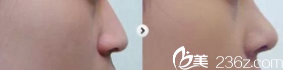 channel整形外科醫(yī)院自體軟骨隆鼻前后效果 channel整形外科醫(yī)院自體軟骨隆鼻前后效果