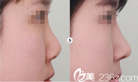 隆鼻手術案例對比圖 隆鼻手術案例對比圖