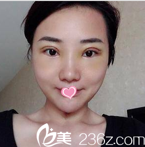 找馬群做切開(kāi)雙眼皮和祛眼袋第11天<span style= 找馬群做切開(kāi)雙眼皮和祛眼袋第11天<span style=