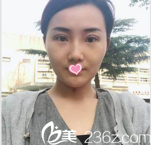 北京畫美整形醫(yī)院馬群雙眼皮祛眼袋<span style= 北京畫美整形醫(yī)院馬群雙眼皮祛眼袋<span style=