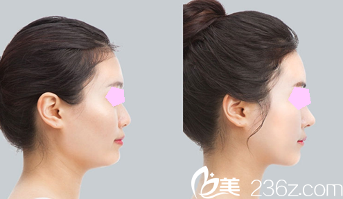 太原華美整形<!--<i data=20240703-sp></i>-->鼻綜合隆鼻前后效果對比圖 太原華美整形<!--<i data=20240703-sp></i>-->鼻綜合隆鼻前后效果對比圖