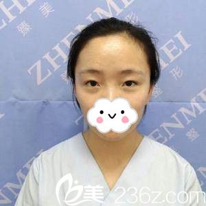 手術(shù)前單眼皮的我 手術(shù)前單眼皮的我