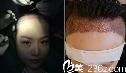 發(fā)際線種植后第10天的樣子 發(fā)際線種植后第10天的樣子