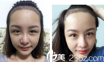 種植后第40天的樣子 種植后第40天的樣子